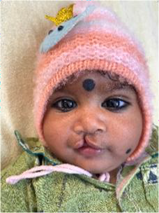 Foto Baby Lippenspalte Indien